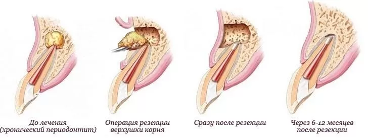 Резекция верхушки корня при периодоните с сохранением зуба